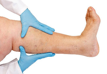NanoVein is used for the treatment of varicose veins, thrombosis-related disorders
