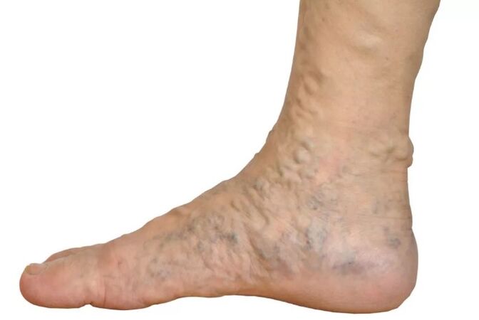 Diseases on the legs