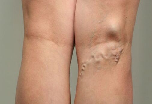 Intravenous disease