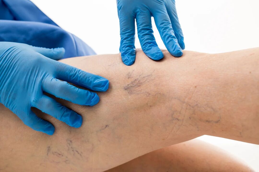 Vein network