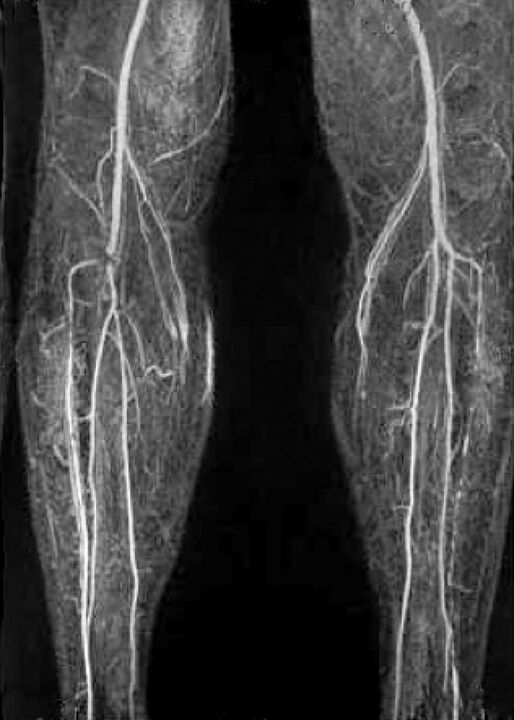 Vascular X-ray