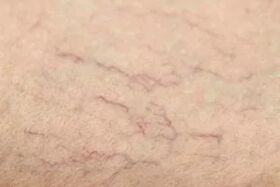 Vascular star