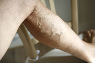 What are the contraindications for varicose veins