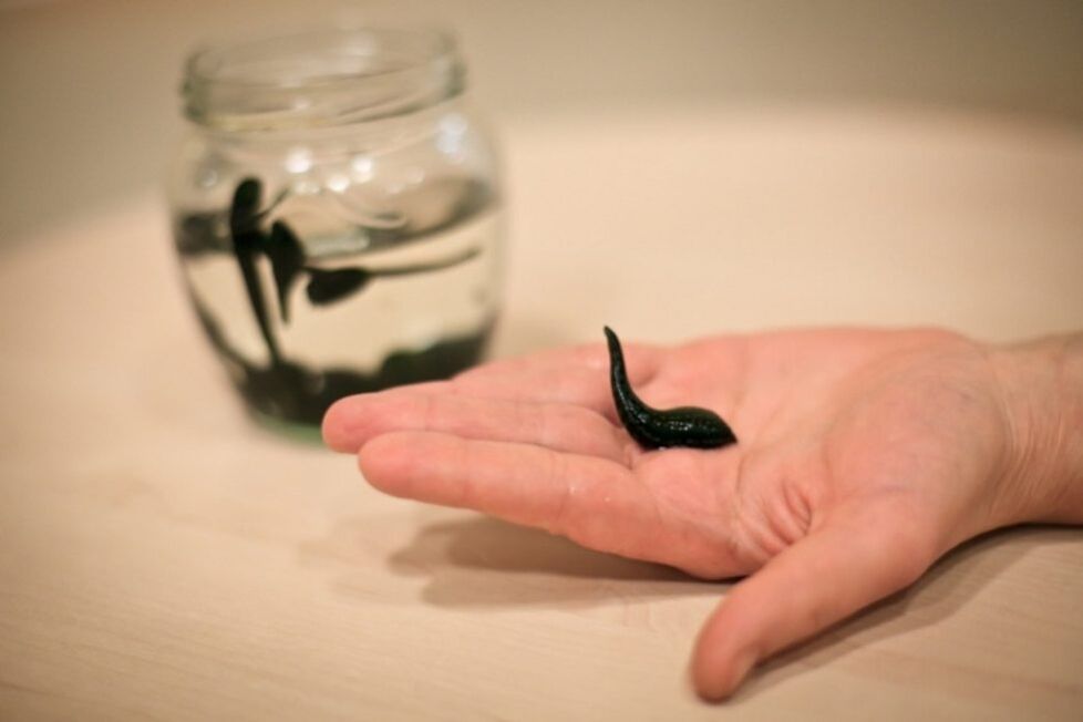 Leech therapy for varicose veins