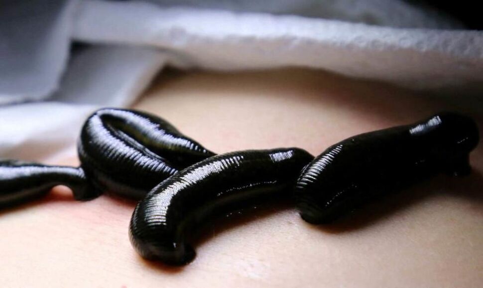 Leeches to treat varicose veins