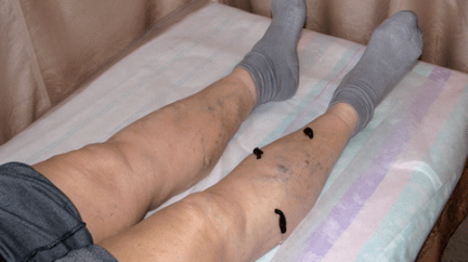 Leeches to treat varicose veins