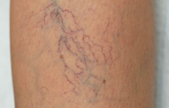 Varicose veins in female legs