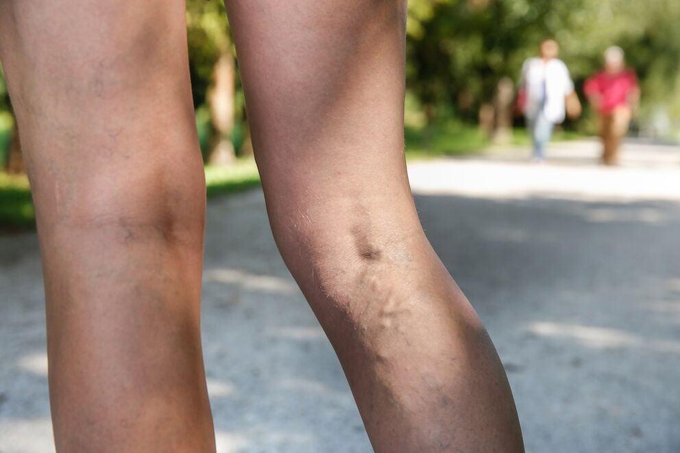 Varicose veins in legs