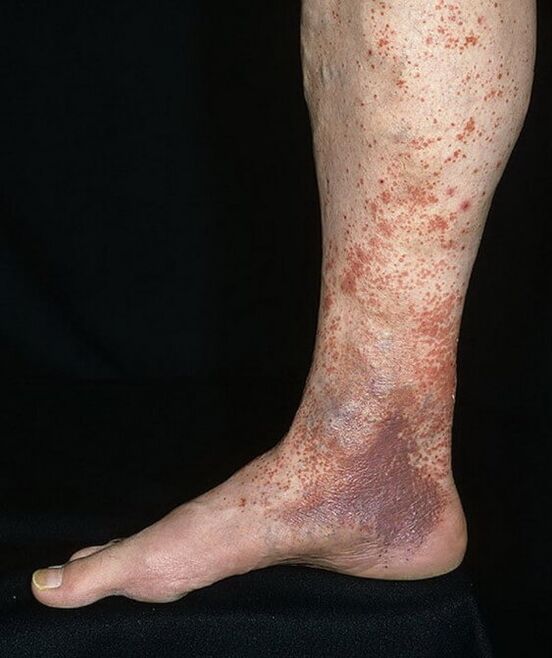 Varicocele dermatitis