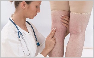 A woman consulted a doctor for obvious signs of varicose veins
