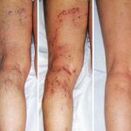 Varicose veins in legs