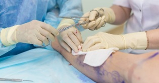Rehabilitation after vein removal
