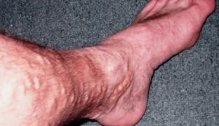Causes of varicose veins on men's legs