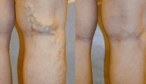 Signs and symptoms of varicose veins in men