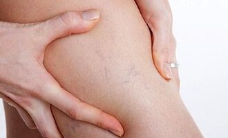 Causes of varicose veins in legs