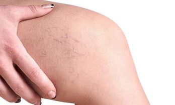 Stages of development of varicose veins