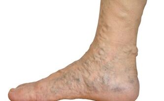 Varicose Vein Forms
