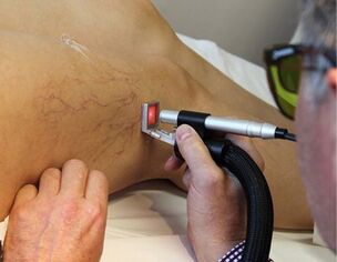 Contraindications of laser treatment of varicose veins