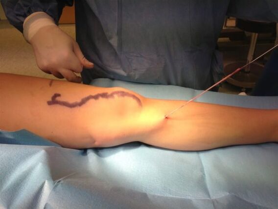 Stripping varicose veins