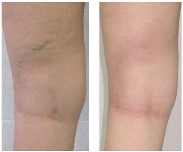 Leg veins before and after varicose vein treatment