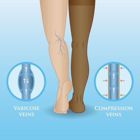 The effect of compression clothing on varicose veins of the legs