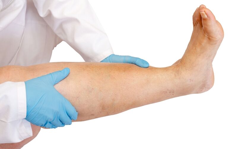 Doctor examines varicose veins in the legs