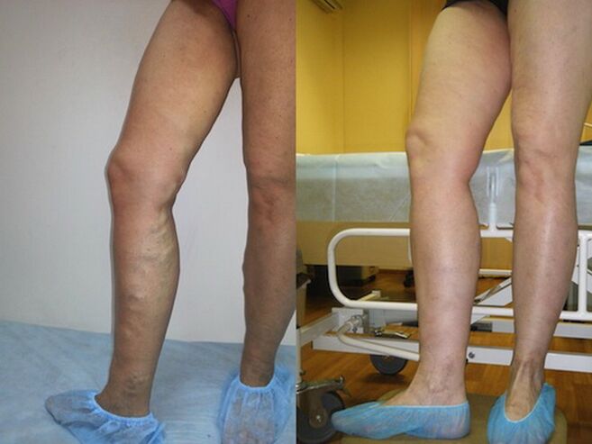 Varicose Vein Laser Treatment Before and After Legs