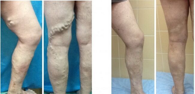 Varicose veins radiofrequency occlusion of the front and rear legs