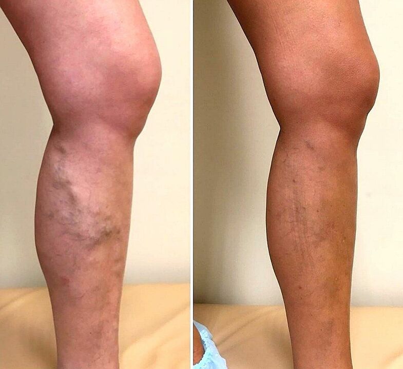 Before and after using apple cider vinegar to treat varicose veins