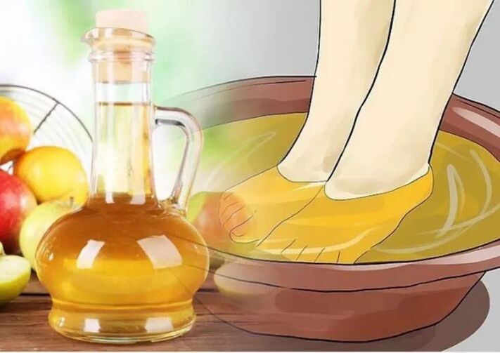 Take a bath with apple cider vinegar to fight varicose veins