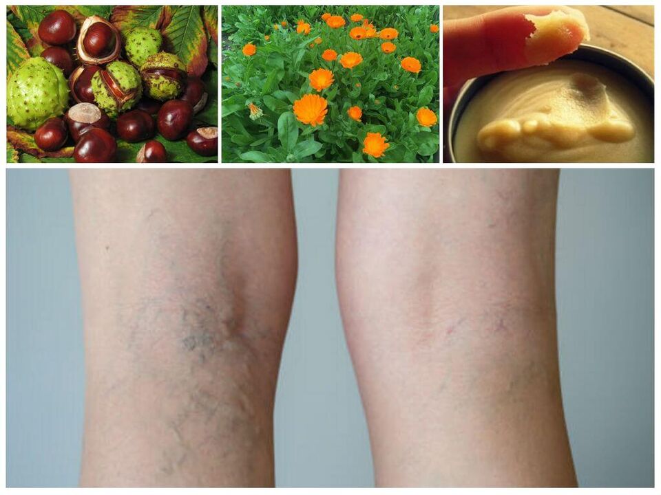 Varicose veins on the legs and its prevention folk remedies