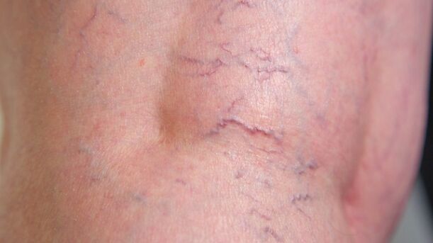 Signs of reticular varicose veins of the lower extremities-dilation of fine veins and vascular reticulum