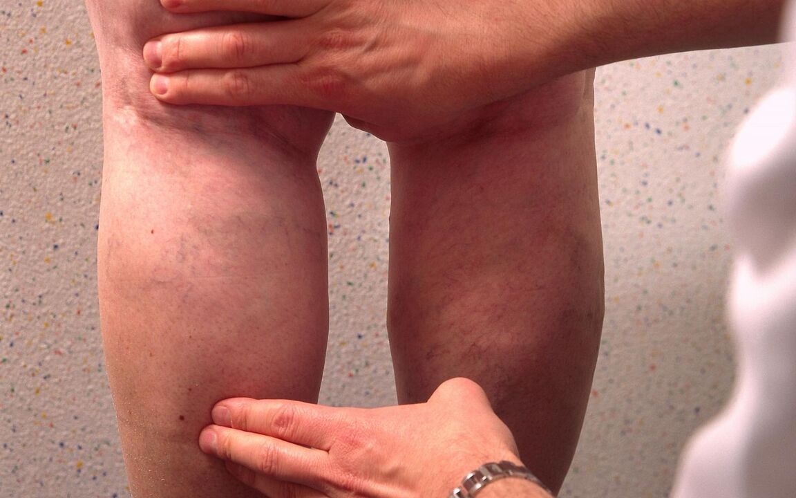 Doctor checking varicose veins on the legs