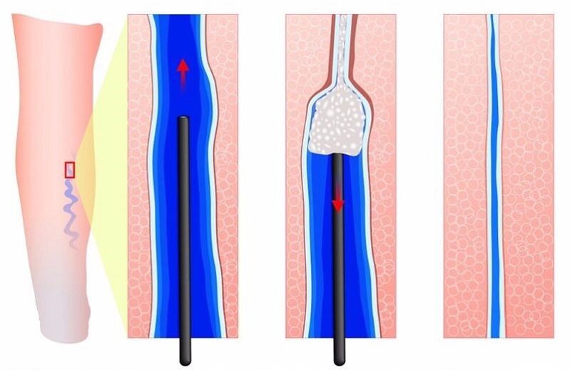 Sclerotherapy for leg varicose veins in men