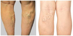 varicose veins of the veins of the legs