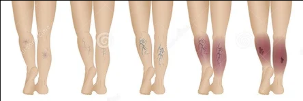 Varicose veins of the lower limbs - phase
